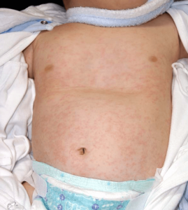 突発性発疹の症状の写真　赤い斑点